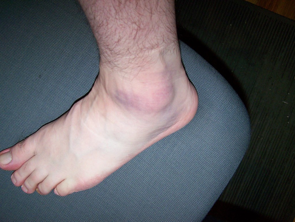swollen purple ankle a photo on Flickriver