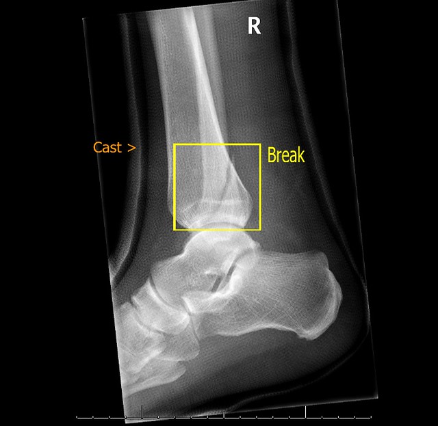 Broken Ankle Xray Xray of my broken ankle. The break is … Flickr