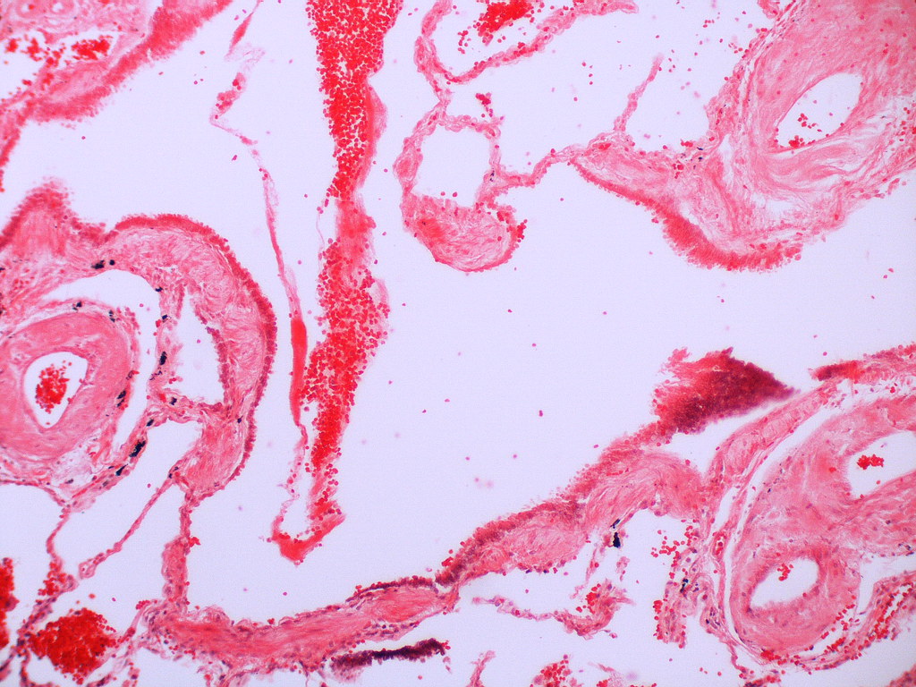 Amyloidosis, diffuse Blood vessel amyloid deposition. Atlas of