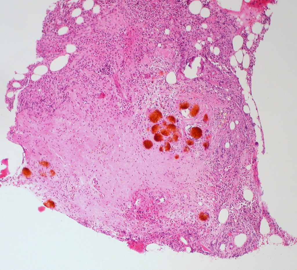 Foreign Material in Bone Marrow (H&E, 100X) Ed Uthman Flickr