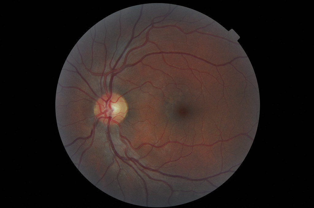 My Right Eye The white dot is the optic nerve., however de… Flickr