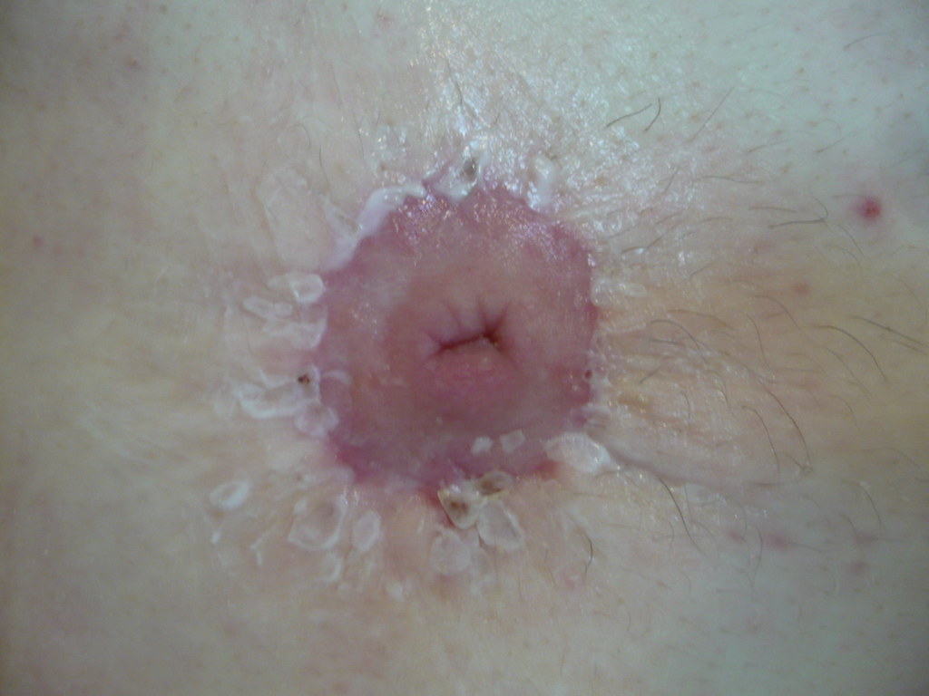 6 weeks right Freshly moisturised Charles Hutchins