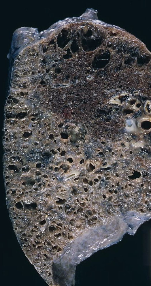 Flickriver Photoset lung' by Pulmonary Pathology Society