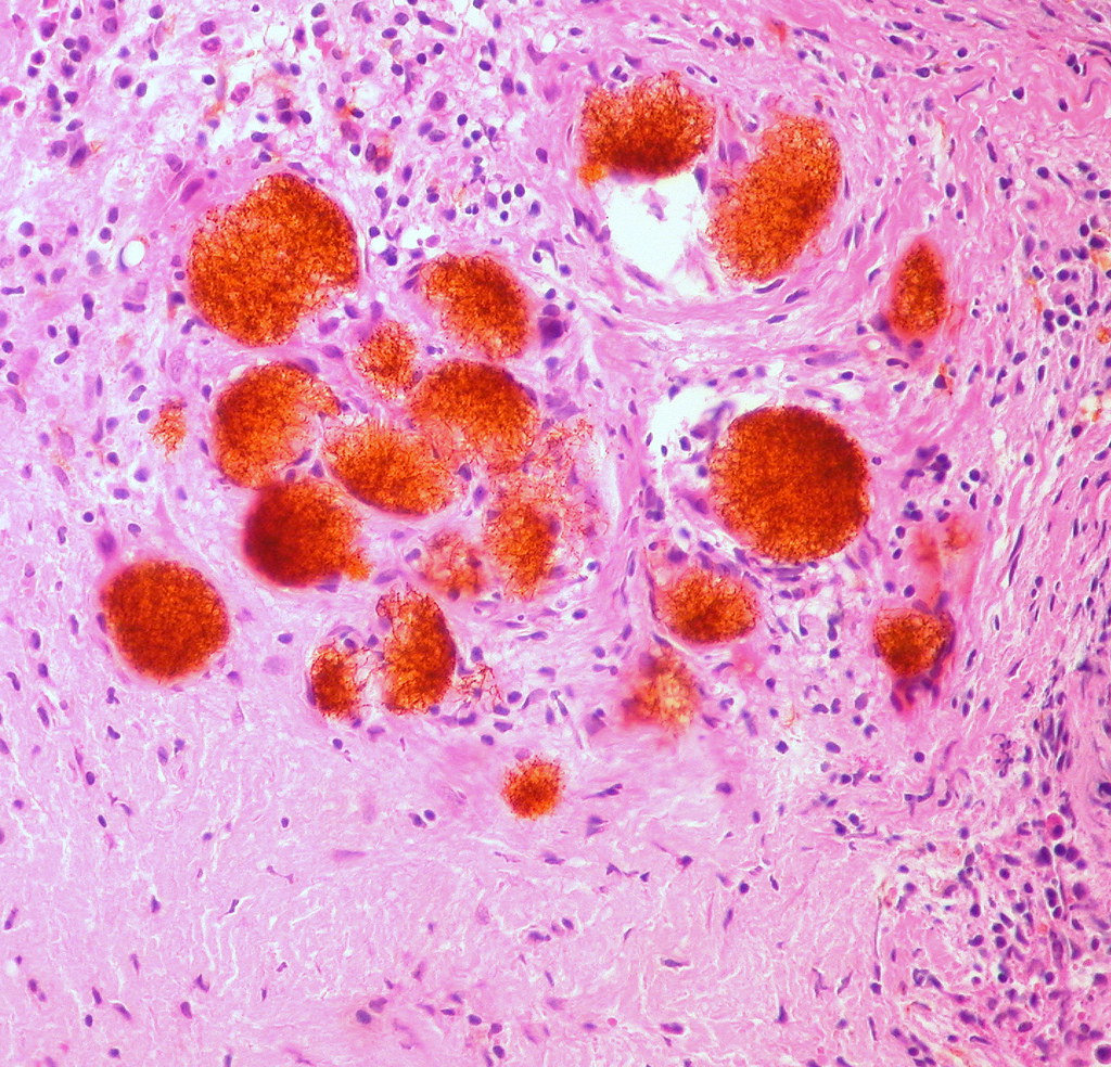 Foreign Material in Bone Marrow (H&E, 400X) a photo on Flickriver