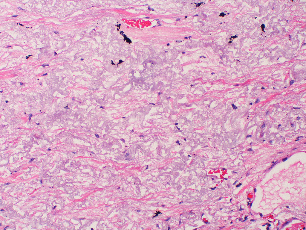 Apical cap Case 142 a photo on Flickriver