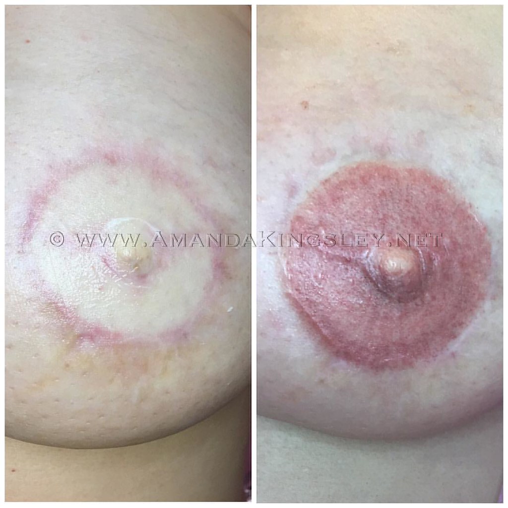 3D Areola Tattooing for a breast cancer survivor! Book you