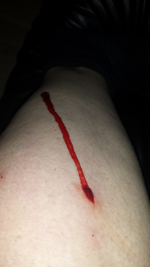 Bleeding Mosquito bite Carol Bassi (Nee McLaughlin) Flickr