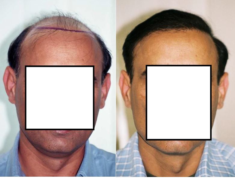 Hair Transplant Surgery Hair Transplant & Cosmetic Facial … Flickr