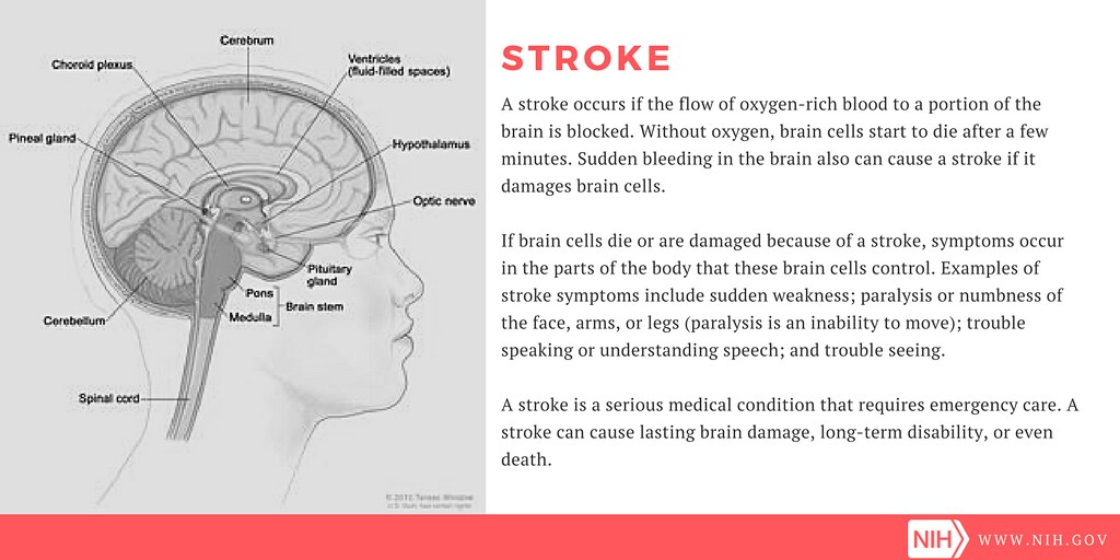 Stroke definition & symptoms A graphic depicting the parts… Flickr