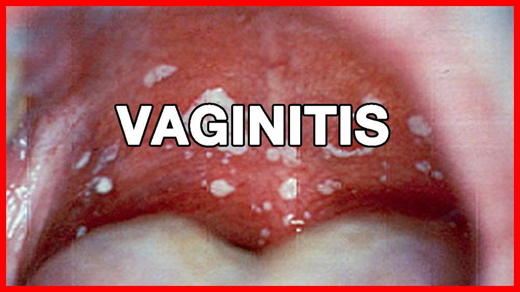 4 Best Home Remedies to Treat Vaginitis. ICD10 Code For V… Flickr