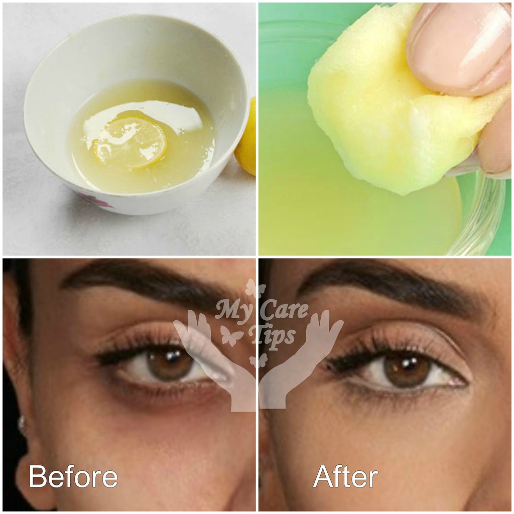 lemon juice for dark circles... Natural remedies for dark … Flickr