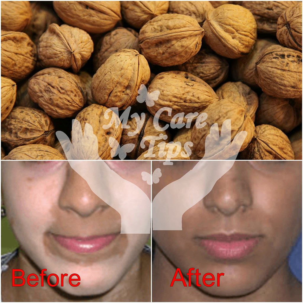 Vitiligo treatment... Home remedy for vitiligo Pulbehri ka… Flickr