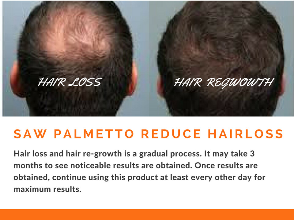 Saw Palmetto Hairloss & Regrowth Hair loss is also known … Flickr