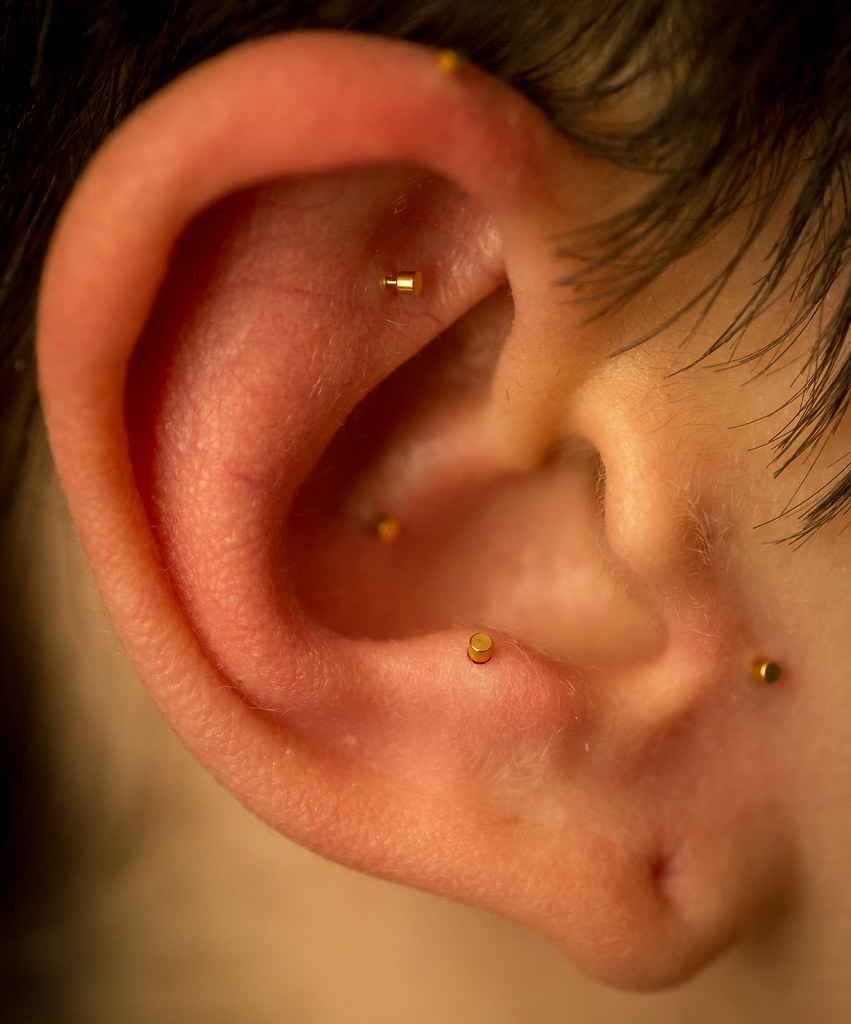 20170621FLW859005 A patient's ear after five needles we… Flickr
