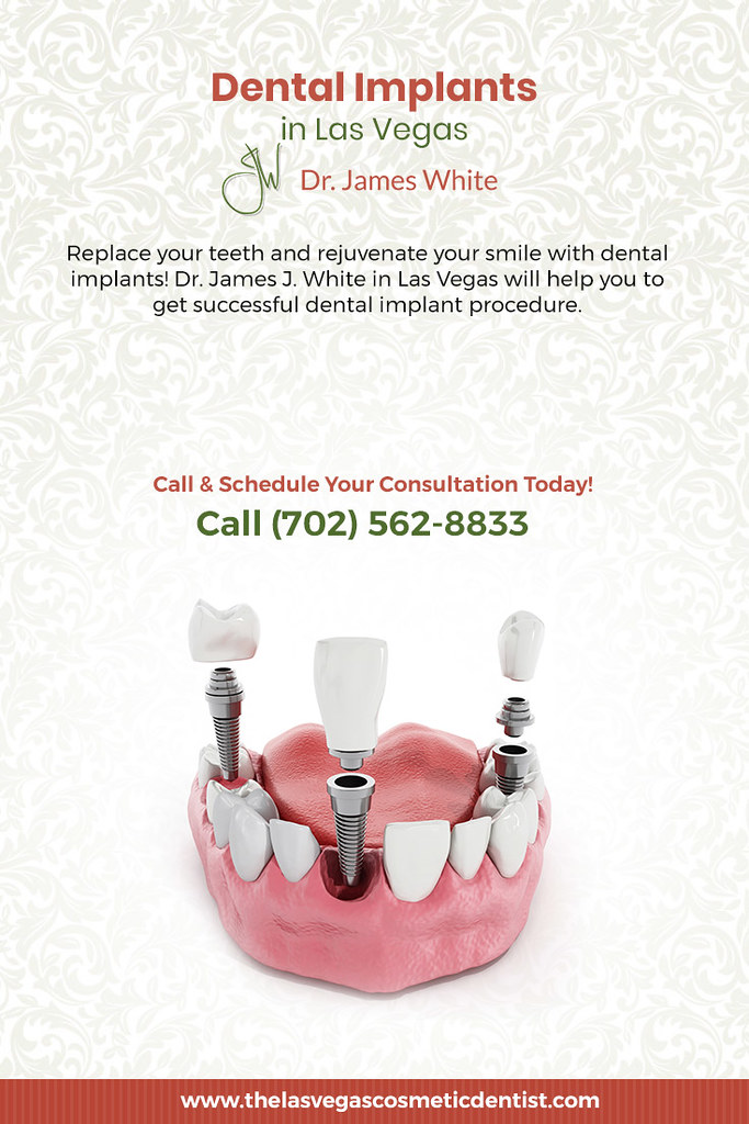 Dental Implants in Las Vegas Dr. James J. White Replace … Flickr