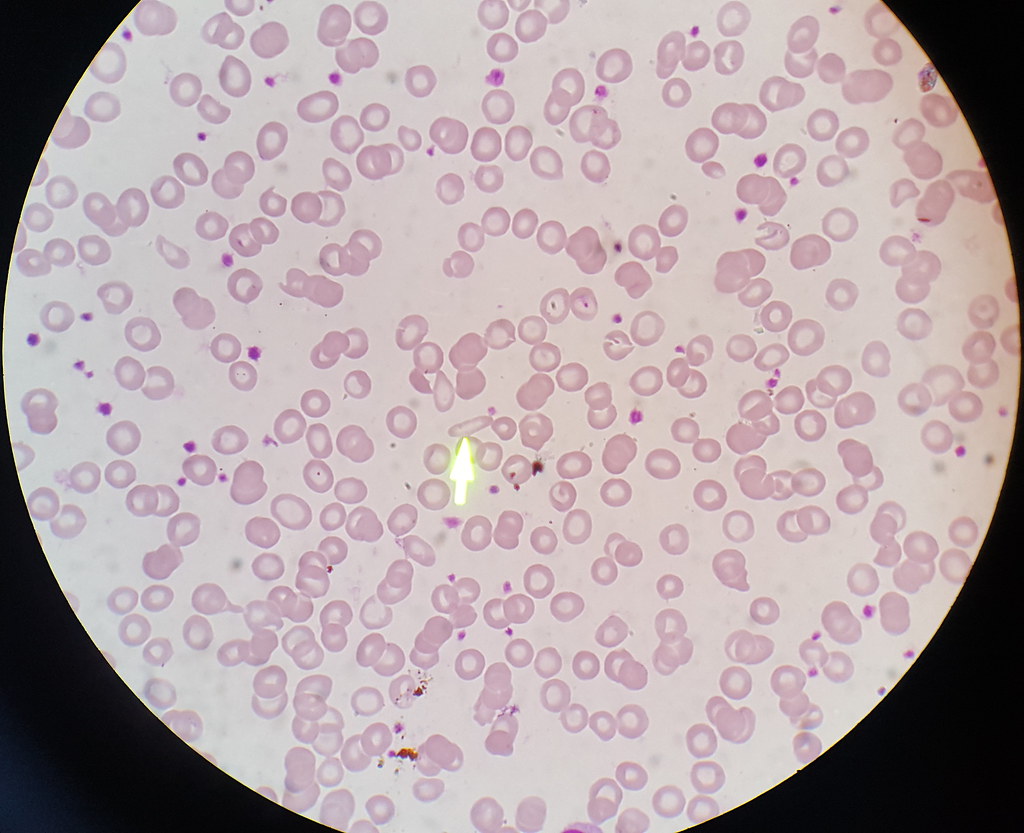 Microcytic Hypochromic Anemia DD Iron Deficiency Anemia 1.… Flickr