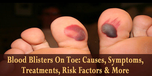 Blood Blisters On Toe Causes, Symptoms, Treatments, Risk … Flickr