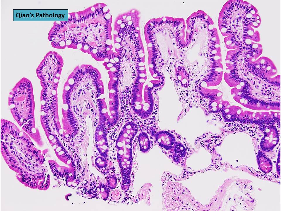 Qiao's Pathology Primary Intestinal Lymphangiectasia a photo on