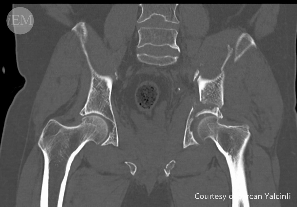 809 Left iliac wing, acetabulum and inferior pubis fract