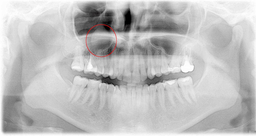 dental cyst again a photo on Flickriver