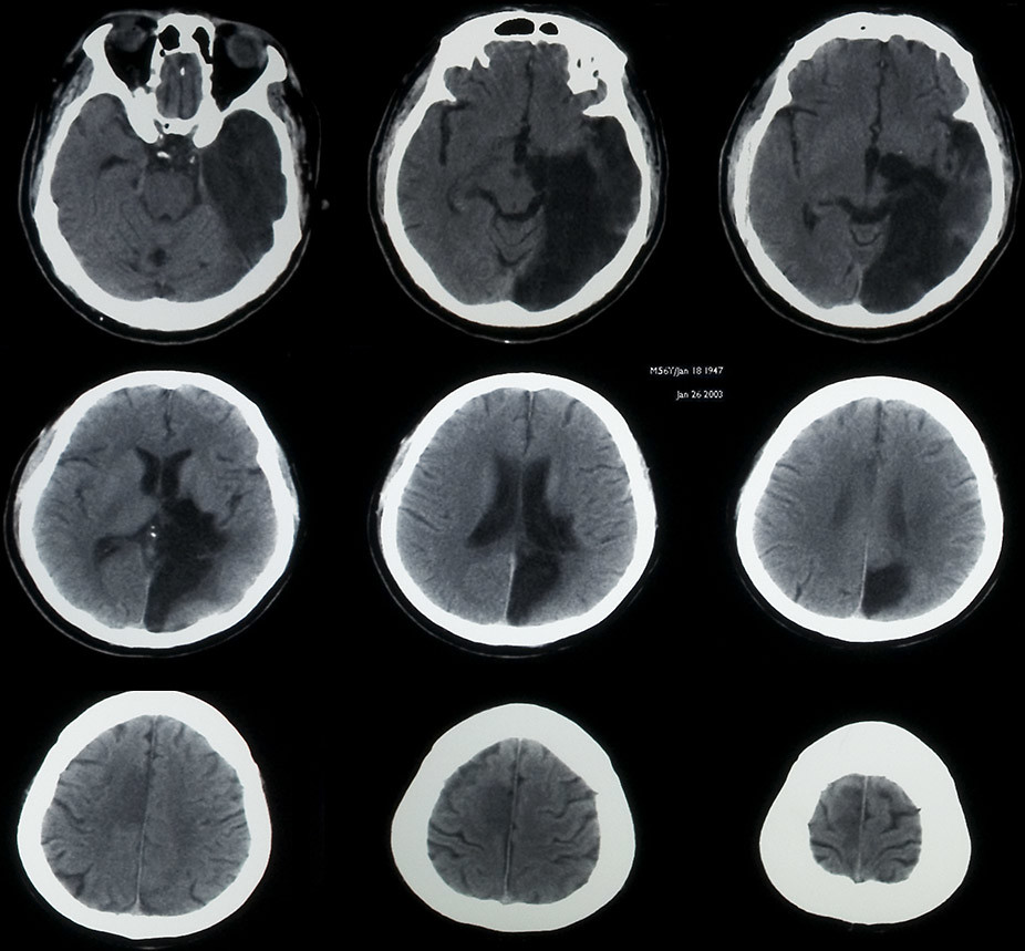 Acute and chronic cerebral infarcts, CT brain Old left PCA… Flickr