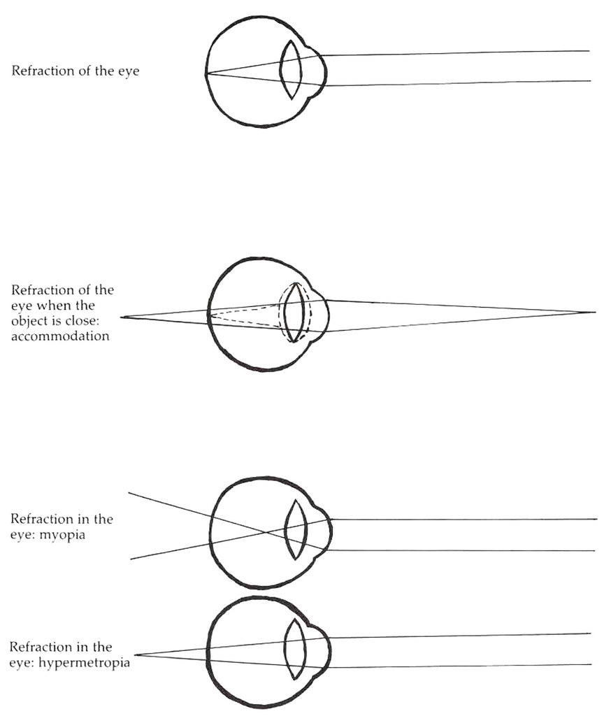 Refraction of the eye myopia, hypermetropia… Flickr