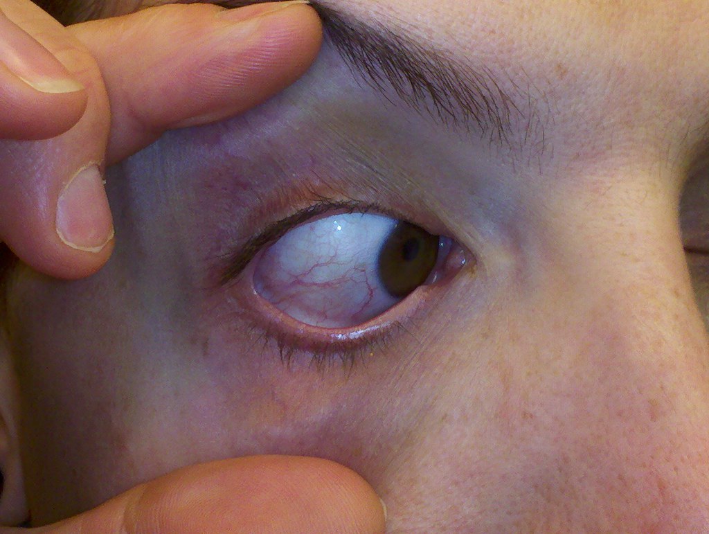 Scratched Cornea Scratched Cornea Medical Treasure If you have