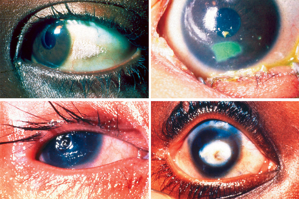 Symptoms and signs of xerophthalmia. Top left An example … Flickr