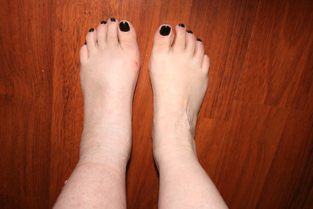Broken ankle swelling after pot taken off Vegan Anstonian Flickr
