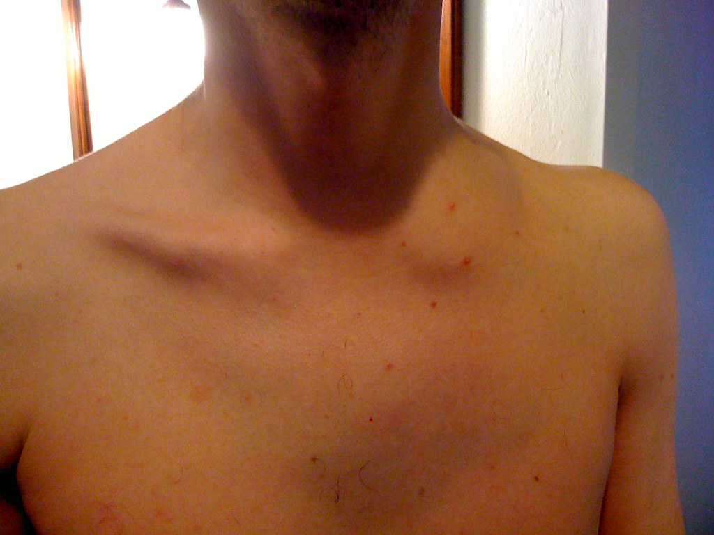 Day 2 Swelling has gone down quite a bit, but now I have a… Flickr