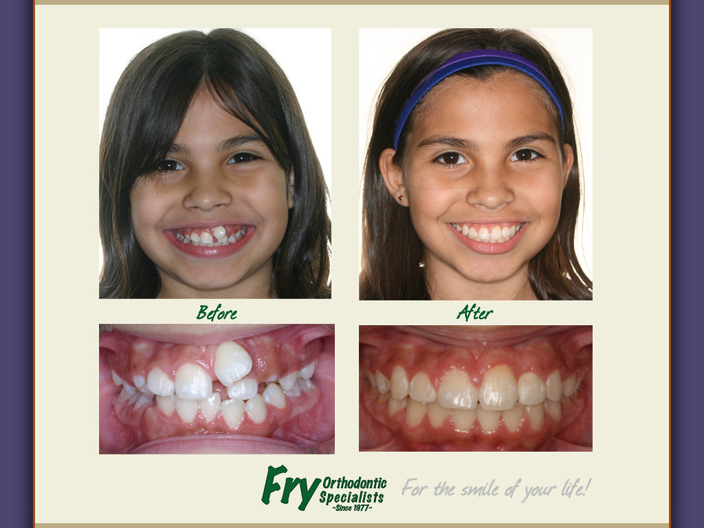 Fry Braces Fry Orthodontic Specialists provides Invisalign… Flickr