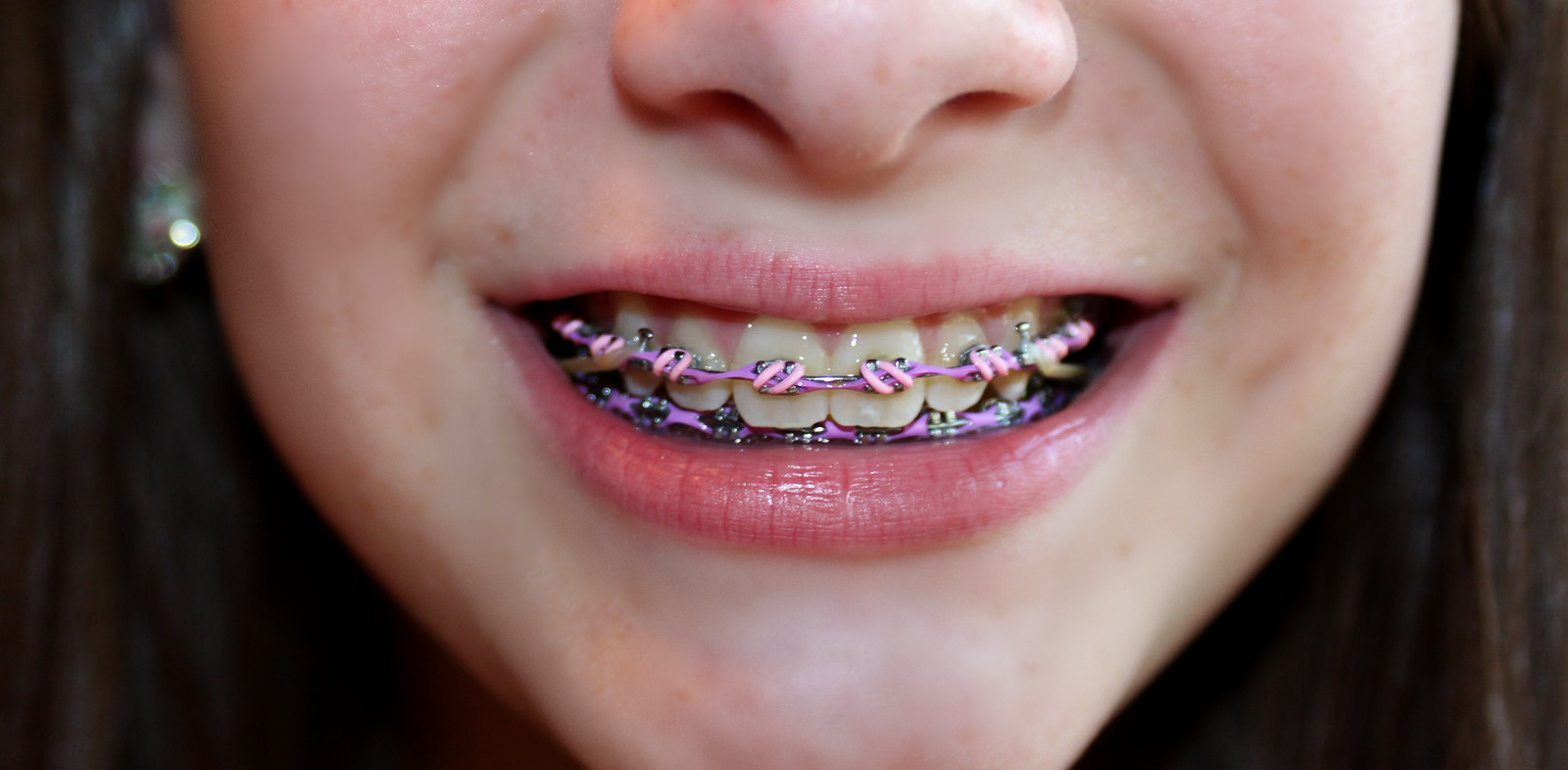 Purple Colored Braces