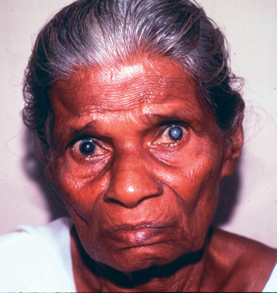 Advanced cataract, left eye, in Sri Lanka. Photo Victoria… Flickr