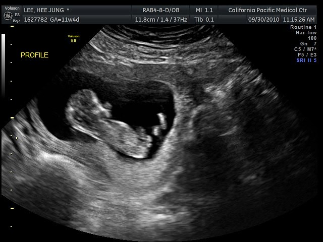 Ultrasound, 11 weeks 4 days heejung Flickr