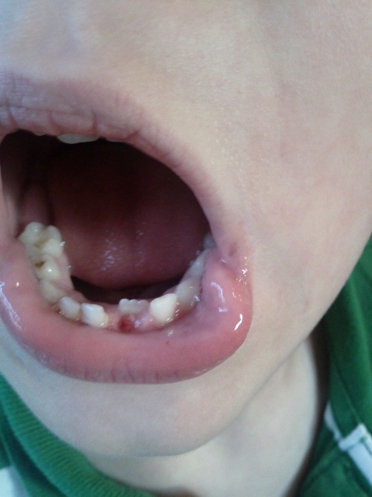 Bloody stump uucmorrow Flickr