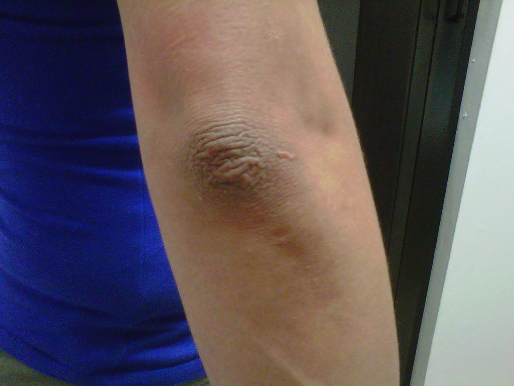 1st Pic Left Elbow The appearance of dark skin on the knee… Flickr