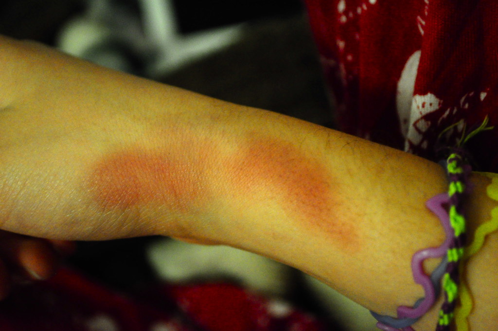 70/365. Volleyball bruise i just keep hurting myself in sp… Flickr