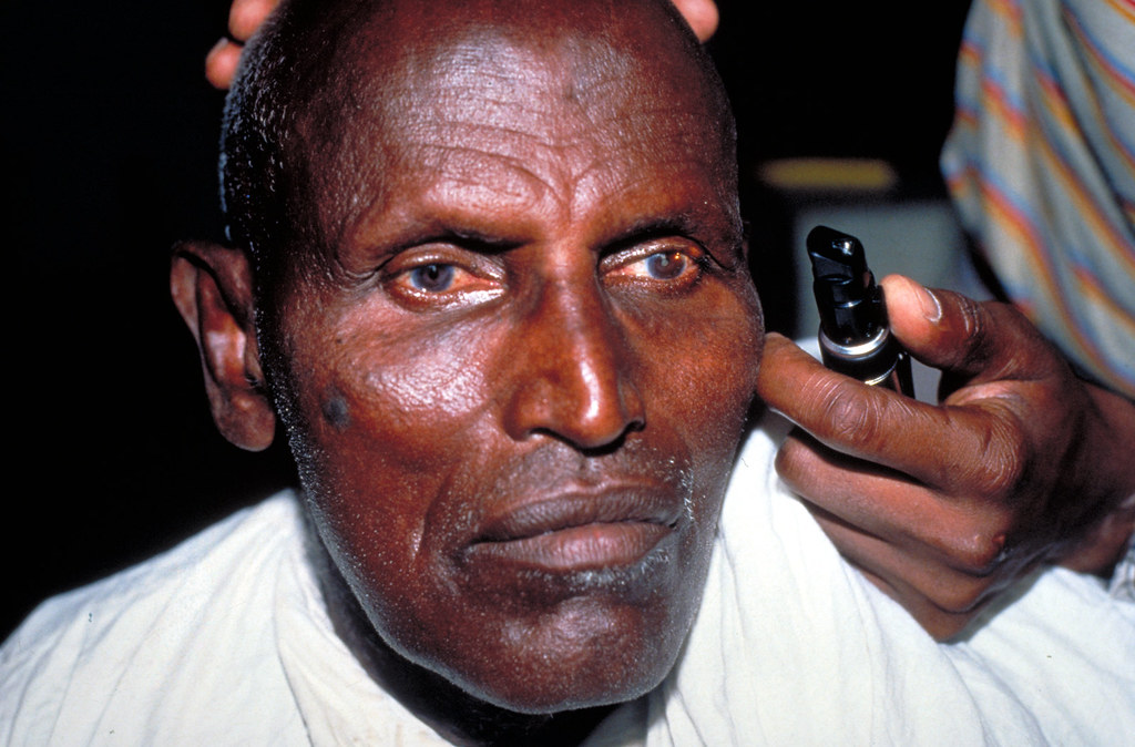 Pupil reaction to light. Photo Murray McGavin Flickr