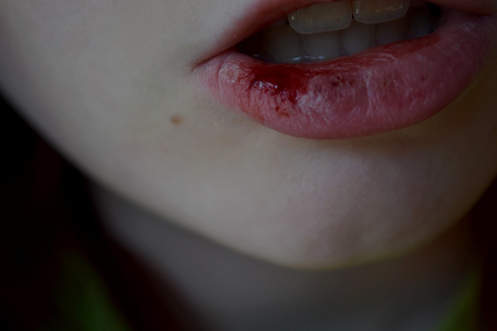 Bleeding Lips Tumblr