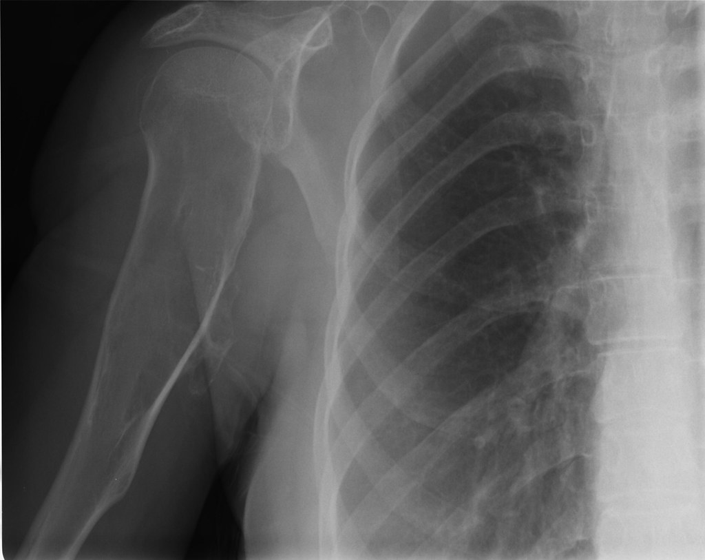 Shoulder Xray Close up I'm a tumor I'm a tumor I'm tumor.… Flickr