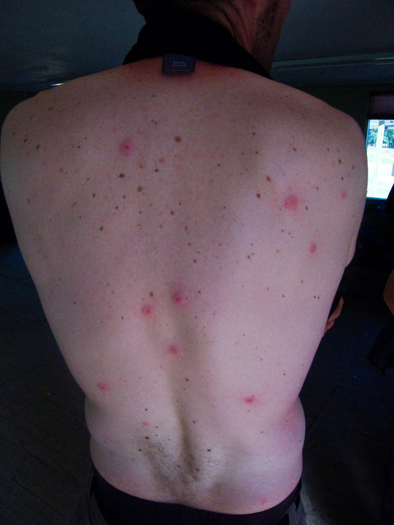 Airsoft back Airsoft wounds. Tiny little plastic balls sho… Flickr