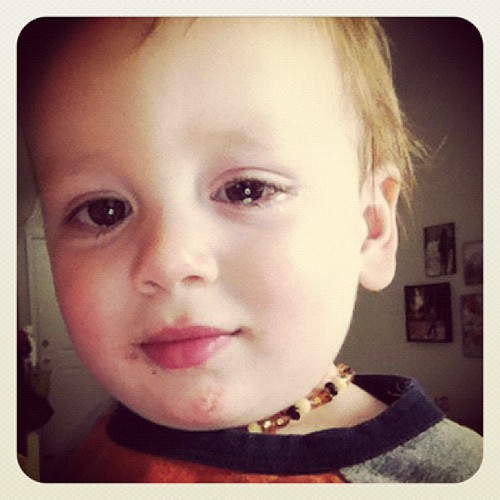 Hand Foot & Mouth blisters at his lip & chin. Pink eye in