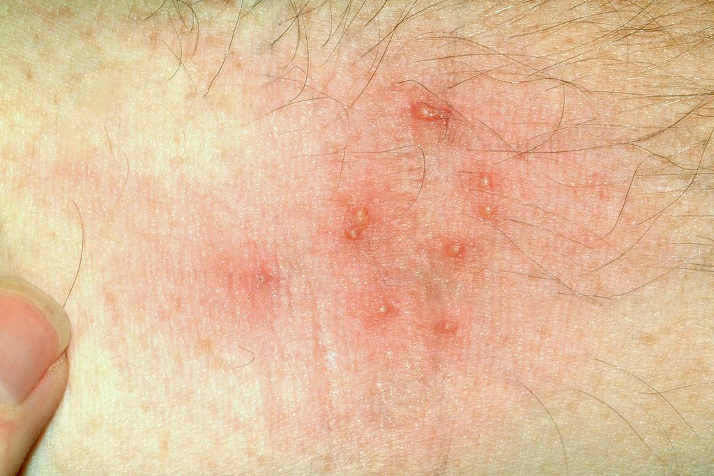 itch mite bites p herfsi James Kalisch Univ. of Nebr… Flickr