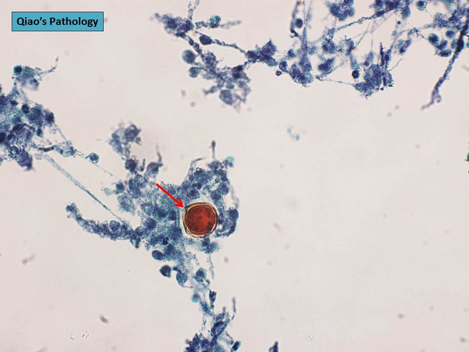 Qiao's Pathology Coccidioides Immitis Infection (San Joaquin Valley