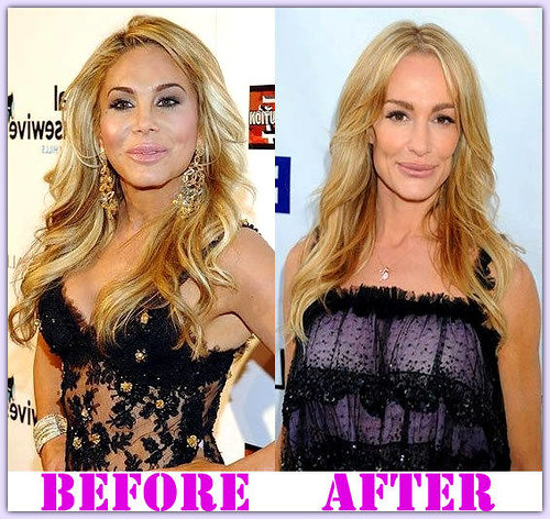 BeverlyHillsPlasticSurgeryBeforeAndAfter In