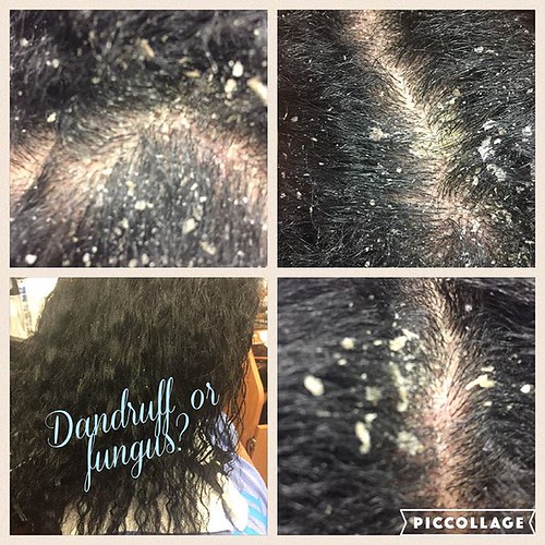 This scalp condition develops from dirty combs! dandruff … Flickr