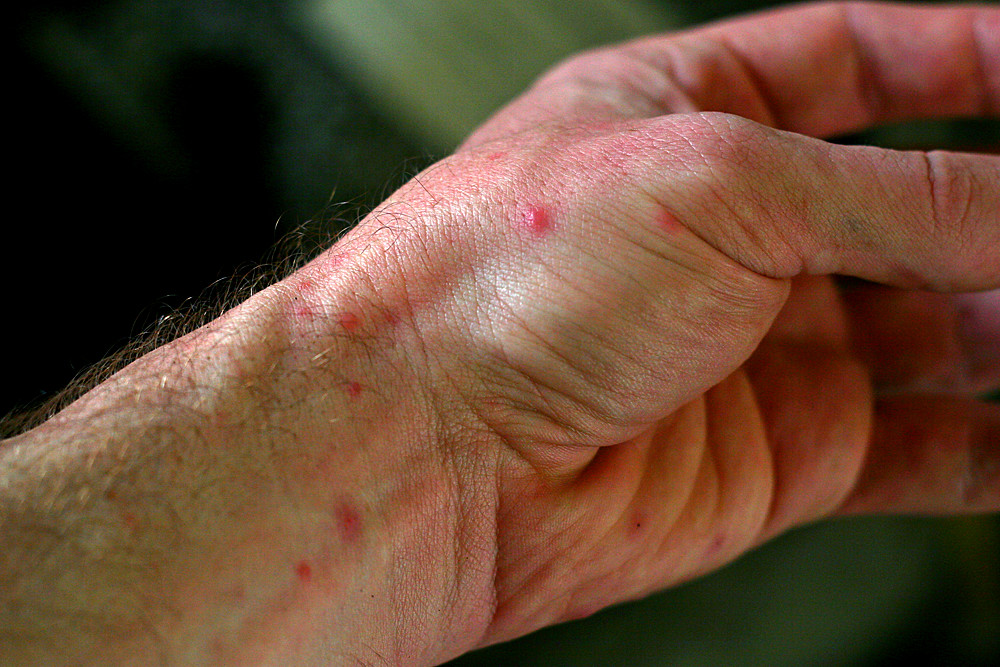 Spider and Bug Bites Chiapas, Mexico Another source of s… Flickr