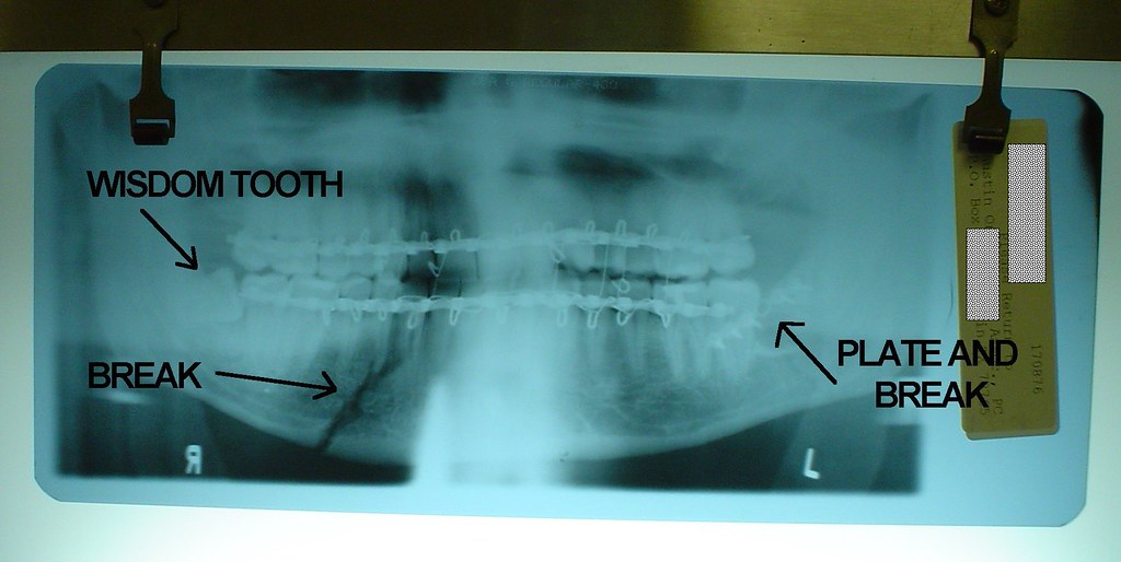 X ray of my jaw after breaking it on 12/30/05 This X ray w… Flickr