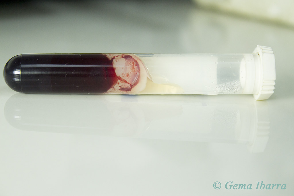 Clotted blood Vial of clotted blood. Red colour. Studio sh… Gema