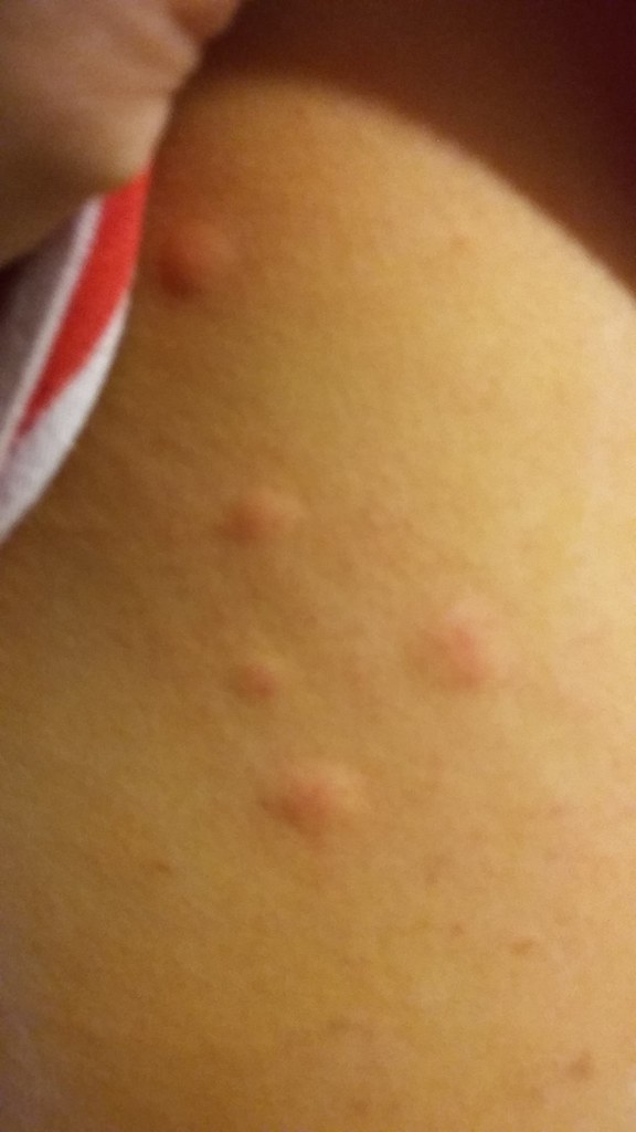 Bump2 bumps showing on upper right torso sinasenest Flickr